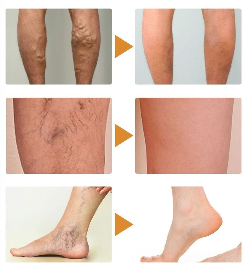 Spray Venofix™: El secreto para Piernas Ligeras, Lisas y Sin Venitas Visibles.