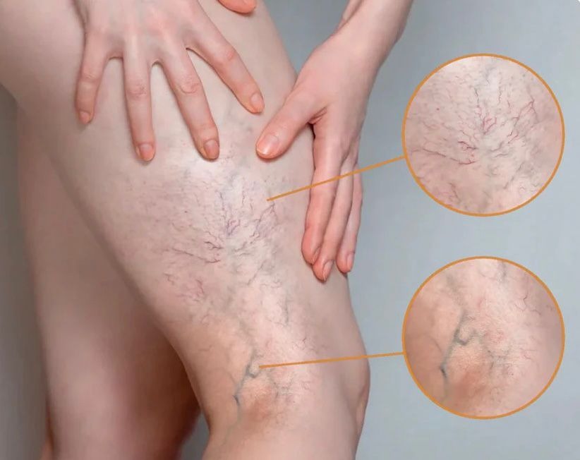 Spray Venofix™: El secreto para Piernas Ligeras, Lisas y Sin Venitas Visibles.