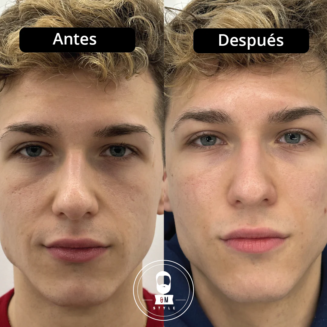 Roll On OM Style™: El Poder de la Cafeína y el Ácido Hialurónico para Despertar Tus Ojos.